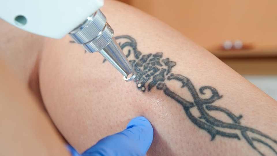 Will White Ink Come out With Laser Tattoo Removal?