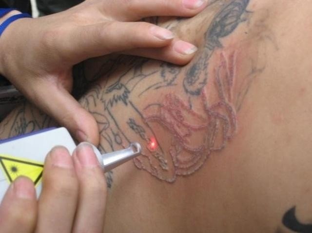 Using Glass Slides To Reduce Pain During Tattoo Removal
