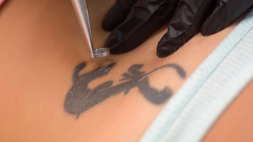 Stuff About Laser Tattoo Removal